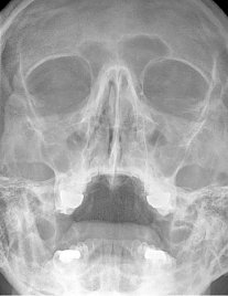 Sinusitis maxillaris acuta (Foto: SHK)