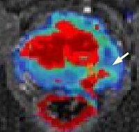 Prostata - Pfeil zeigt auf Karzinom (SHK)