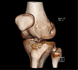 3D CT des Kniegelenks mit freiem Gelenkk&ouml;rper (Foto: SHK)
