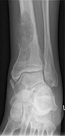Knochenmetastase bei Peniskarzinom (Foto: SHK)