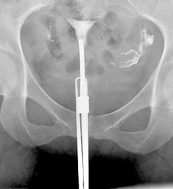 Hysterosalpingografie im Rahmen der Fertilit&auml;tsdiagnostik (Foto: SHK)