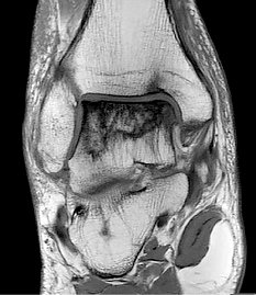 Osteonekrose Talus (Foto: SHK) Osteonekrose Talus (Foto: SHK)