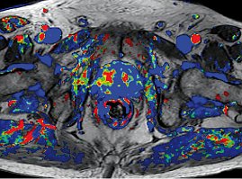 Prostatakarzinom der peripheren Zone in der CAD-Auswertung der Dynamik (Foto: SHK) Prostatakarzinom der peripheren Zone in der CAD-Auswertung der Dynamik (Foto: SHK)