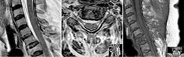 epidurales Hämatom cervical (Foto: SHK) epidurales Hämatom cervical (Foto: SHK)