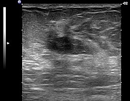 intramamm&auml;res Fibrolipom (Foto: SHK)