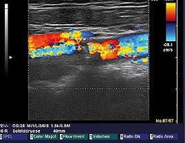 Carotisstenose im Doppler (Foto: SHK)