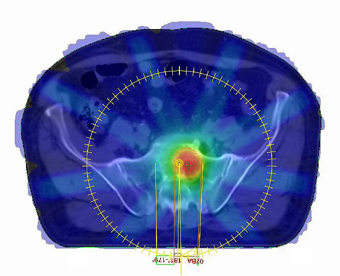 Dosisverteilung solit&auml;re Metastase (Foto: SHK)